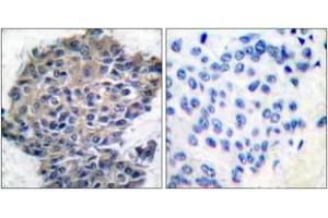 Immunohistochemistry analysis of paraffin-embedded human breast carcinoma, using Filamin A (Phospho-Ser2152) Antibody. (Filamin A 抗体  (pSer2152))