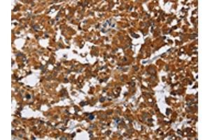 The image on the left is immunohistochemistry of paraffin-embedded Human thyroid cancer tissue using ABIN7128790(CAT Antibody) at dilution 1/40, on the right is treated with fusion protein. (Catalase 抗体)