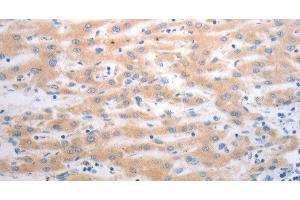 Immunohistochemistry of paraffin-embedded Human liver cancer using PAK1 Polyclonal Antibody at dilution of 1:40 (PAK1 抗体)