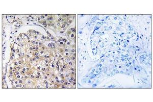 Immunohistochemistry analysis of paraffin-embedded human breast carcinoma tissue using GPR116 antibody. (G Protein-Coupled Receptor 116 抗体  (C-Term))