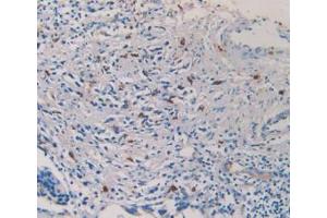 IHC-P analysis of Human Prostate Gland Cancer Tissue, with DAB staining. (TPSAB1 抗体  (AA 161-262))