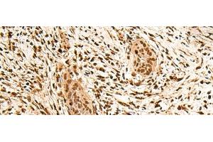 Immunohistochemistry of paraffin-embedded Human esophagus cancer tissue using PPM1G Polyclonal Antibody at dilution of 1:40(x200) (PPM1G 抗体)