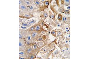 Formalin-fixed and paraffin-embedded human lung carcinoma tissue reacted with CYP2W1 antibody (N-term), which was peroxidase-conjugated to the secondary antibody, followed by DAB staining. (CYP2W1 抗体  (N-Term))