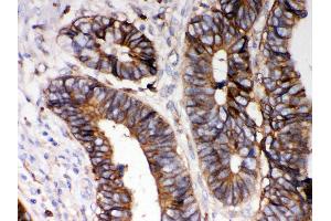 Anti- HLA-A Picoband antibody,IHC(P) IHC(P): Human Intestinal Cancer Tissue (HLA-A 抗体  (N-Term))