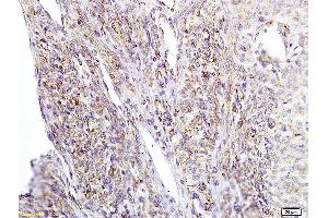 Formalin-fixed and paraffin embedded human cervical carcinoma labeled with Anti APE/Girdin Polyclonal Antibody, Unconjugated (ABIN755587) at 1:200 followed by conjugation to the secondary antibody and DAB staining (Girdin 抗体  (AA 1401-1500))