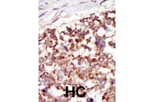 Formalin-fixed and paraffin-embedded human hepatocellular carcinoma tissue reacted with the PAK4 polyclonal antibody  , which was peroxidase-conjugated to the secondary antibody, followed by DAB staining. (PAK4 抗体  (N-Term))