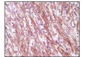 Immunohistochemical analysis of paraffin-embedded human smooth musde sarcoma, showing cytoplasmic localization using Desmin mouse mAb with DAB staining. (Desmin 抗体)