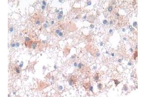 Detection of NCAD in Human Glioma Tissue using Polyclonal Antibody to N-cadherin (NCAD) (N-Cadherin 抗体  (AA 685-784))