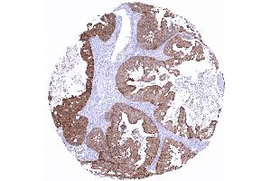 Ovary Mucinous ovarian cancer showing strong villin immunostaining (Recombinant Villin 1 抗体  (AA 600-700))