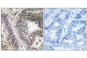 Immunohistochemical analysis of paraffin-embedded human colon carcinoma tissue using WWOX (Phospho-Tyr33) antibody (left)or the same antibody preincubated with blocking peptide (right).