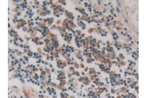 DAB staining on IHC-P; Samples: Human Stomach cancer Tissue (PKIG 抗体  (AA 1-76))
