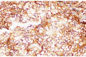 Immunohistochemistry of paraffin-embedded Human kidney cancer using FOLH1 Polycloanl Antibody at dilution of 1:200 (PSMA 抗体)
