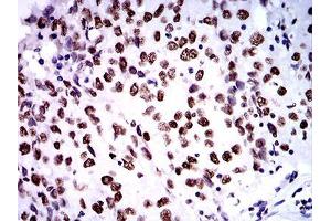 Immunohistochemical analysis of paraffin-embedded ovarian cancer tissues using ZFP91 mouse mAb with DAB staining. (ZFP91 抗体  (AA 162-304))