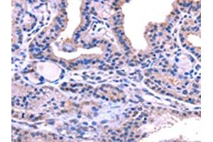 The image on the left is immunohistochemistry of paraffin-embedded Human thyroid cancer tissue using ABIN7131472(TRIM14 Antibody) at dilution 1/40, on the right is treated with fusion protein. (TRIM14 抗体)