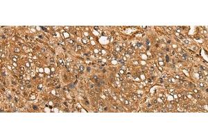 Immunohistochemistry of paraffin-embedded Human liver cancer tissue using CALML6 Polyclonal Antibody at dilution of 1:55(x200) (CALML6 抗体)