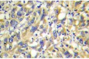Immunohistochemistry  (IHC) analyzes of MKP-4 antibody in paraffin-embedded human liver carcinoma tissue. (DUSP9 抗体)