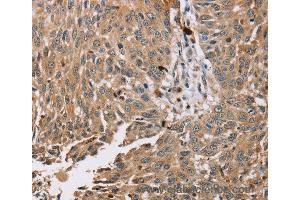 Immunohistochemistry of Human esophagus cancer using PDLIM7 Polyclonal Antibody at dilution of 1:35 (PDLIM7 抗体)