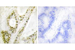 Immunohistochemistry analysis of paraffin-embedded human colon carcinoma tissue using IRF-3 (Phospho-Ser385) antibody. (IRF3 抗体  (pSer385))