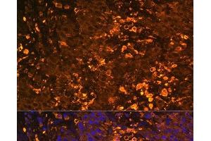 Immunofluorescence analysis of Human liver cancer using UGT1A1 Polyclonal Antibody at dilution of 1:100.