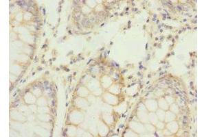 Immunohistochemistry of paraffin-embedded human colon cancer using ABIN7159199 at dilution of 1:100 (REC8 抗体  (AA 1-270))