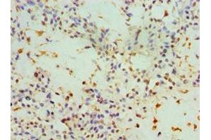 Immunohistochemistry of paraffin-embedded human breast cancer using ABIN7143947 at dilution of 1:100