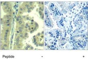 Imunohistochemical analysis of paraffin-embedded human lung carcinoma tissue, using EIF4G1 polyclonal antibody . (EIF4G1 抗体  (Ser1232))