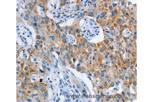 Immunohistochemistry of Human thyroid cancer using ASL Polyclonal Antibody at dilution of 1:35 (ASL 抗体)