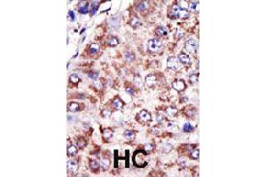Formalin-fixed and paraffin-embedded human hepatocellular carcinoma tissue reacted with FDFT1 polyclonal antibody  , which was peroxidase-conjugated to the secondary antibody, followed by DAB staining . (FDFT1 抗体  (N-Term))