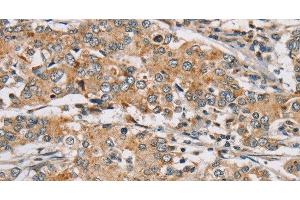 Immunohistochemistry of paraffin-embedded Human liver cancer tissue using RAB24 Polyclonal Antibody at dilution 1:45 (RAB24 抗体)