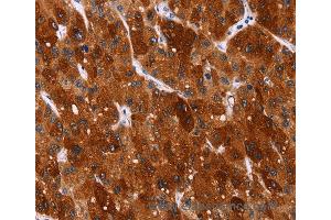 Immunohistochemistry of Human gastric cancer using HSPB6 Polyclonal Antibody at dilution of 1:40 (HSPB6 抗体)