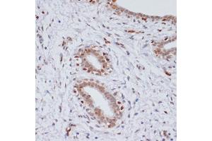 Immunohistochemistry of paraffin-embedded human breast cancer using TriMethyl-Histone H3-K27 antibody (ABIN3023268, ABIN3023269, ABIN3023270, ABIN1513002 and ABIN6219521) at dilution of 1:100 (40x lens). (Histone 3 抗体  (H3K27me))