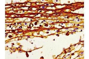 Immunohistochemistry of paraffin-embedded human melanoma using ABIN7155249 at dilution of 1:100 (HDC 抗体  (AA 504-648))