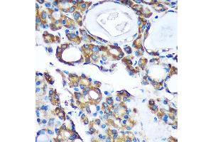 Immunohistochemistry of paraffin-embedded Human thyroid cancer using PDXDC1 Rabbit pAb (ABIN7269759) at dilution of 1:100 (40x lens). (PDXDC1 抗体  (AA 489-788))