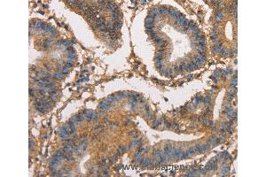 Immunohistochemistry of Human thyroid cancer using HK3 Polyclonal Antibody at dilution of 1:40 (HK3 抗体)