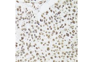 Immunohistochemistry of paraffin-embedded human esophageal cancer using SFPQ antibody (ABIN5970351) at dilution of 1/100 (40x lens). (SFPQ 抗体)
