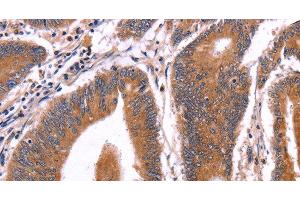Immunohistochemistry of paraffin-embedded Human colon cancer tissue using CRISP3 Polyclonal Antibody at dilution 1:50 (CRISP3 抗体)