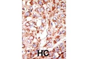 Formalin-fixed and paraffin-embedded human cancer tissue reacted with the primary antibody, which was peroxidase-conjugated to the secondary antibody, followed by DAB staining. (Acsl3 抗体  (N-Term))