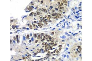 Immunohistochemistry of paraffin-embedded Human colon carcinoma using DACH1 Polyclonal Antibody at dilution of 1:100 (40x lens). (DACH1 抗体)