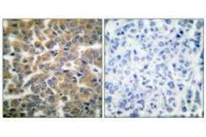 Immunohistochemical analysis of paraffin-embedded human breast carcinoma tissue using GR (Ab-211) antibody. (Glucocorticoid Receptor 抗体  (Ser211))
