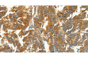Immunohistochemistry of paraffin-embedded Human gastric cancer using ASNS Polyclonal Antibody at dilution of 1:60 (Asparagine Synthetase 抗体)