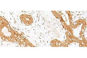 Immunohistochemistry of paraffin-embedded Human breast cancer tissue using GOLGA7 Polyclonal Antibody at dilution of 1:40(x200) (Golgin A7 抗体)