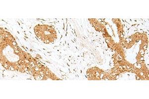 Immunohistochemistry of paraffin-embedded Human breast cancer tissue using GOLGA7 Polyclonal Antibody at dilution of 1:40(x200) (Golgin A7 抗体)