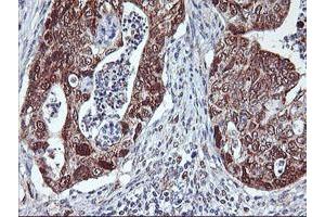Immunohistochemical staining of paraffin-embedded Carcinoma of Human pancreas tissue using anti-NLN mouse monoclonal antibody. (NLN 抗体)