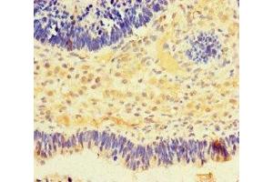 Immunohistochemistry of paraffin-embedded human ovarian cancer using ABIN7161580 at dilution of 1:100 (NMNAT2 抗体  (AA 1-153))