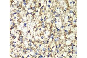 Immunohistochemistry of paraffin-embedded Human kidney cancer using PTGES2 Polyclonal Antibody at dilution of 1:100 (40x lens). (PTGES2 抗体)