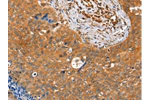 The image on the left is immunohistochemistry of paraffin-embedded Human cervical cancer tissue using ABIN7128162(ACOT11 Antibody) at dilution 1/25, on the right is treated with fusion protein. (ACOT11 抗体)