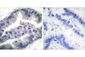 P-peptide - +Immunohistochemical analysis of paraffin-embedded human lung carcinoma tissue using BIK (Phospho-Thr33) antibody (#A0053). (BIK 抗体  (pThr33))