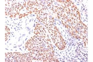 Formalin-fixed, paraffin-embedded Lung Squamous Cell Carcinoma stained with p40 Rabbit Polyclonal Antibody.