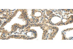 Immunohistochemistry of paraffin-embedded Human thyroid cancer tissue using TMPRSS11E Polyclonal Antibody at dilution 1:45 (TMPRSS11E 抗体)