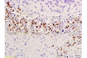 Formalin-fixed and paraffin embedded human endometrium carcinoma labeled with Anti-TIMP-4 Polyclonal Antibody, Unconjugated  at 1:300, followed by conjugation to the secondary antibody and DAB staining (TIMP4 抗体  (AA 161-224))